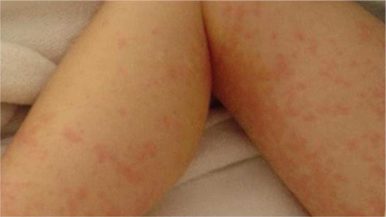 16歲女「手腳脫屑」醫一看驚竟是梅毒！初期1症狀恐誤判