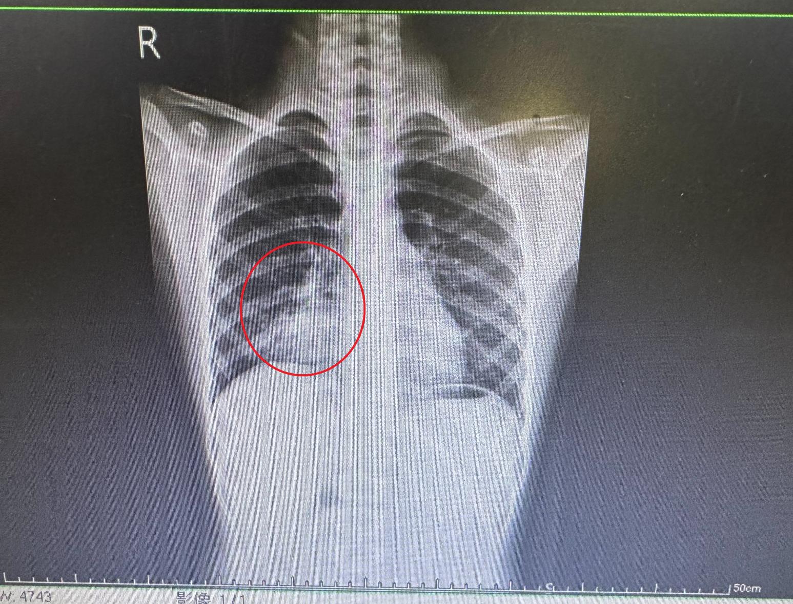 A流好了還在咳！9歲童咳到肋骨痛又高...