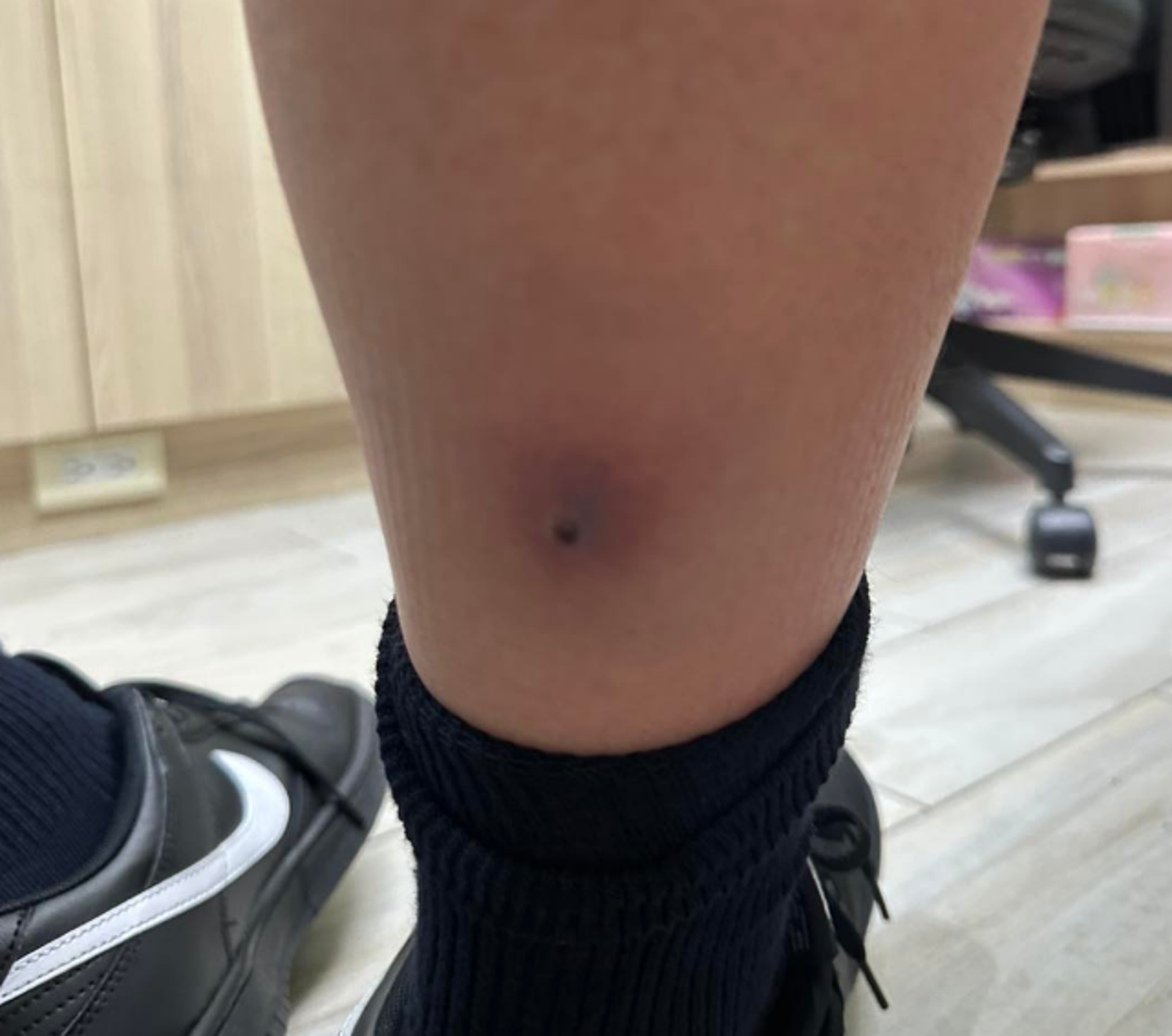 12歲男童發燒「以為是流感」！醫聽完症狀一拉褲管驚呼：快送急診