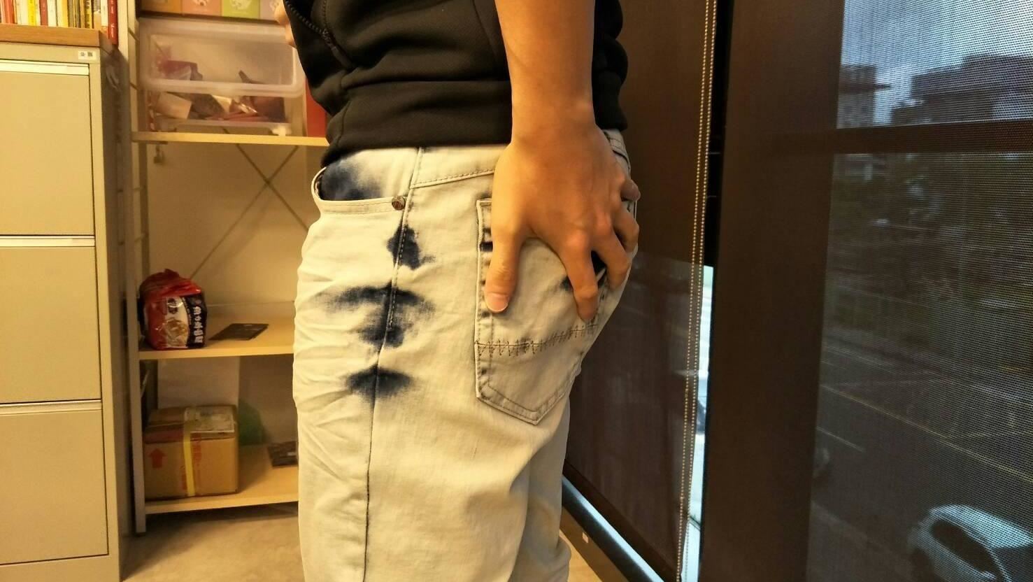 狂放超濃「魚腥味響屁」！人夫拖20年不敢外出用餐　醫嘆：腫瘤已後期