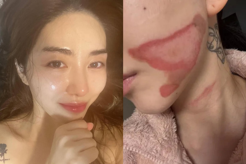 韓女星打音波出包「臉大面積二度燒傷」睡醒崩潰怒喊告