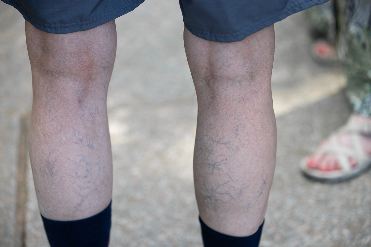 只是站太久？醫揪「靜脈曲張真相」 小心便秘也是幫兇