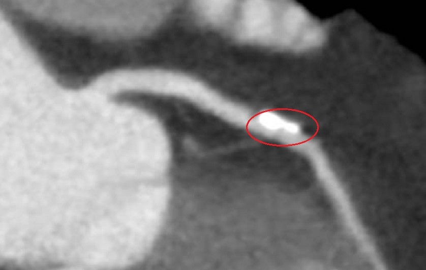 冠狀動脈堵塞、狹窄 「生物適應性支架」助恢復彈性