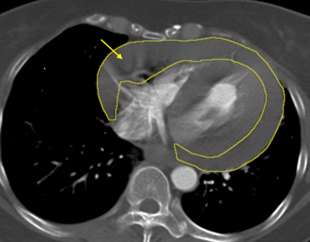 心臟病發摔車 72H接力手術救回