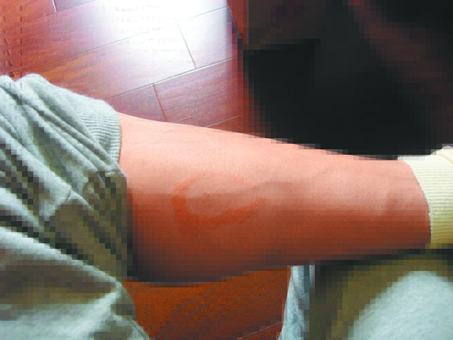 今年首例 婦瑞典返台確診萊姆病