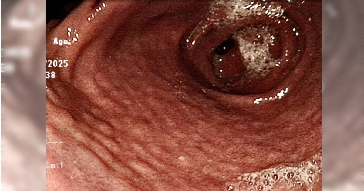 胃痛拖不得！15歲青少年突吐血　照胃鏡檢查！醫驚見「癌前病變」