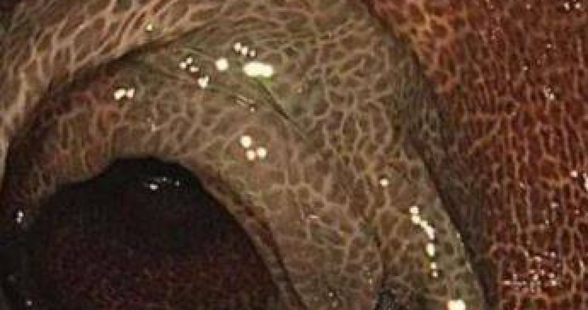 喝通便茶10年！陸女連5天拉不出送醫　慘變「豹紋腸」切30cm保命