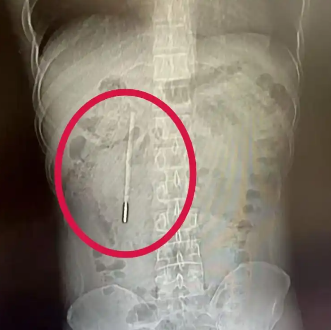 陸男體內藏「水銀體溫計」　12歲時誤吞20年後腹部不適才想起