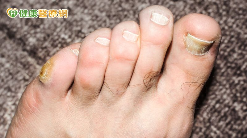 糖友穩定控制血糖卻忽略糖尿病足！醫及...