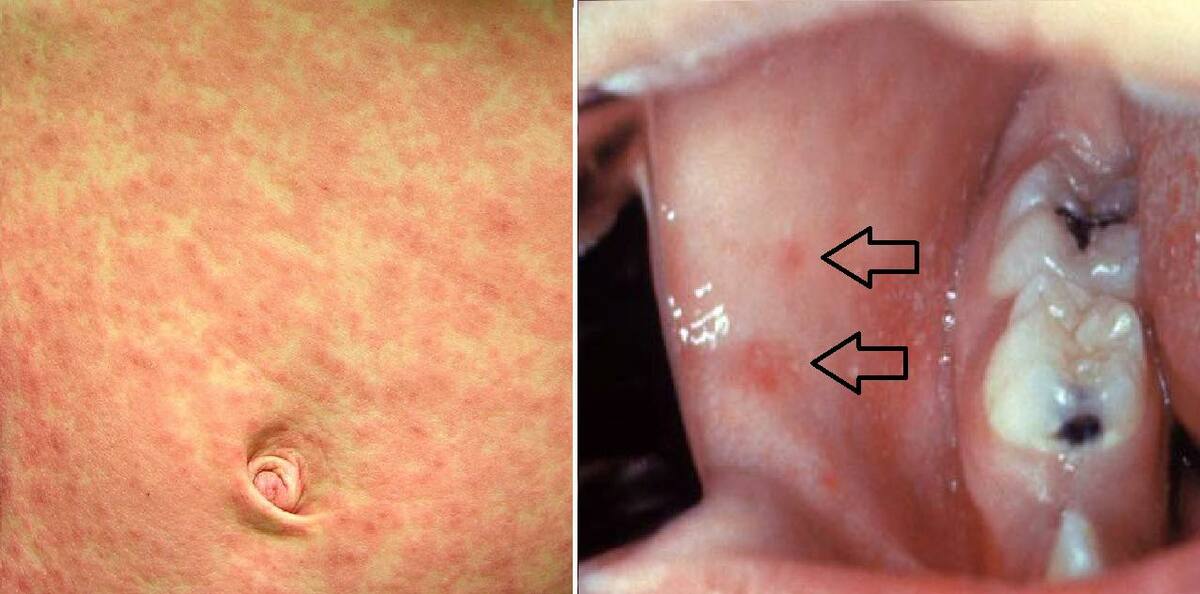 北市麻疹個案曾搭公車、板南線　衛生局籲健康監測