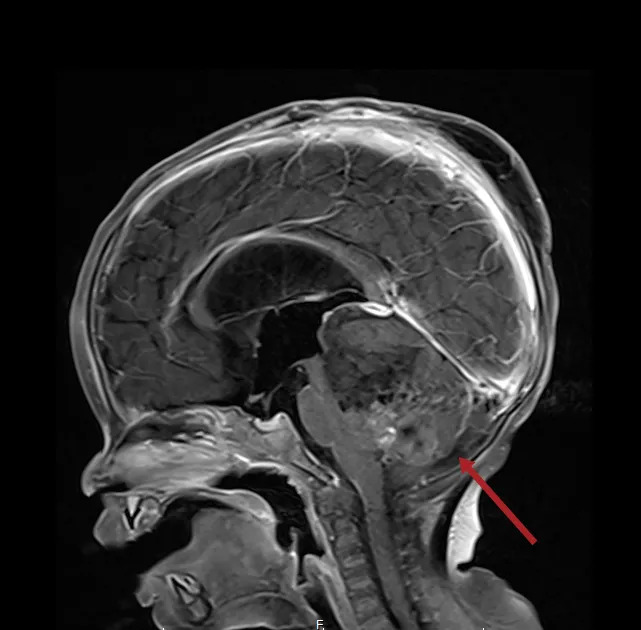 惡性腦瘤難預測　醫揭早期警訊與治療方...