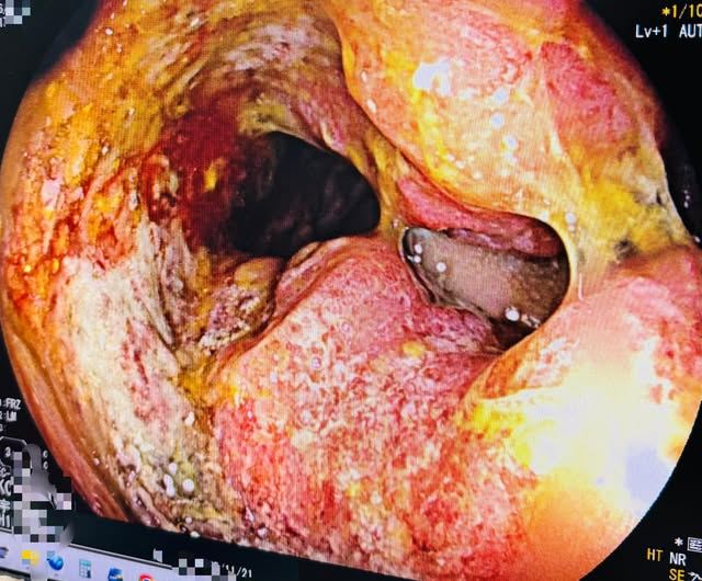 血便半年誤認痔瘡！年節前得知「直腸癌」真相　他豁達一席話超催淚