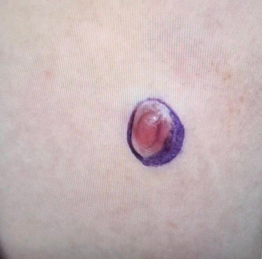 以為只是小痘痘！國中生腹部皮膚硬塊　檢查竟是罕見肉癌