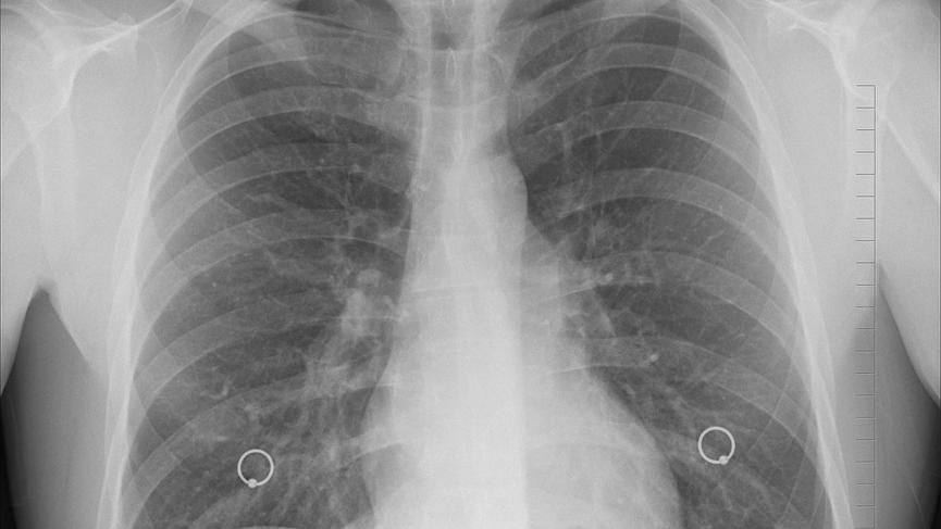 台南老菸槍「肺活量剩29%」僅走百步　奇美醫院靠1招幫回血