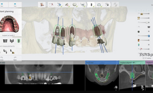 數位進軍牙科助攻植牙精準度治療 醫師：完整評估與假牙設計是關鍵