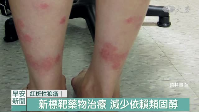 狼瘡性腎炎併發症 新標靶藥精準治療