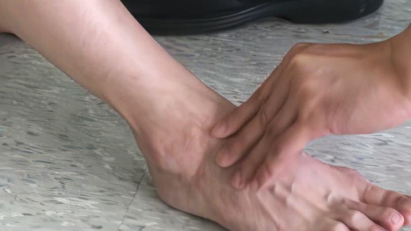 罕病瀨川氏症全台患者約20人 及早發現、規律服藥可改善