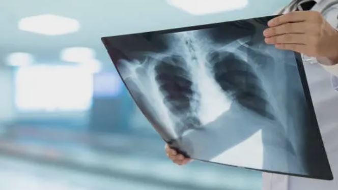 每年奪萬人性命！為什麼不抽菸也會得肺癌？三大關鍵主因找到了