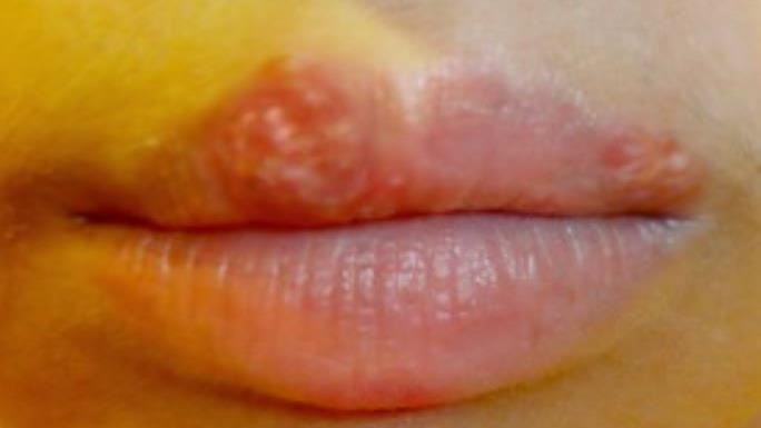 「嘴角起水泡」以為火氣大？30歲女未理會竟導致「腦死」　醫曝4警訊